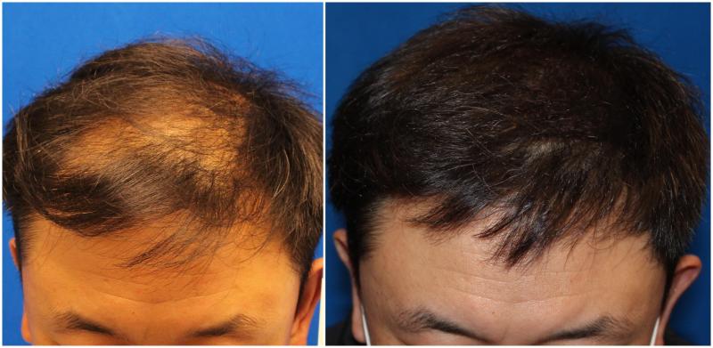 年輕的地中海植發，如何完成自身的升華，找回青春的自信